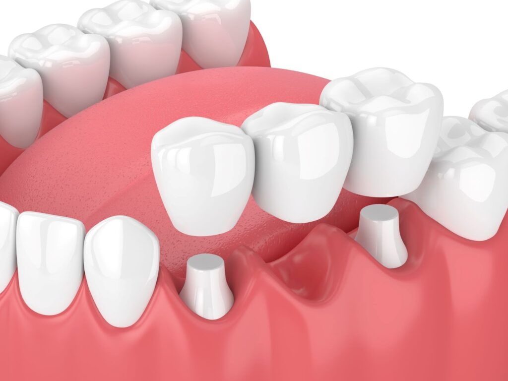 restorative dental care