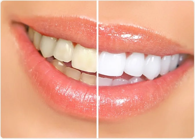 teeth whitening mount colah