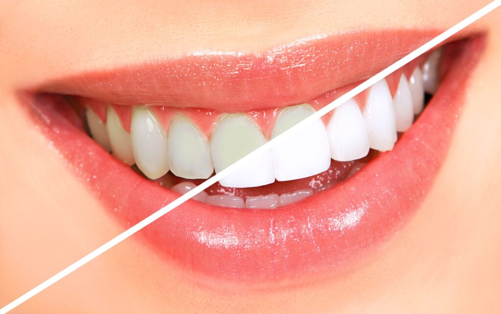 teeth whitening near mount kuringgai