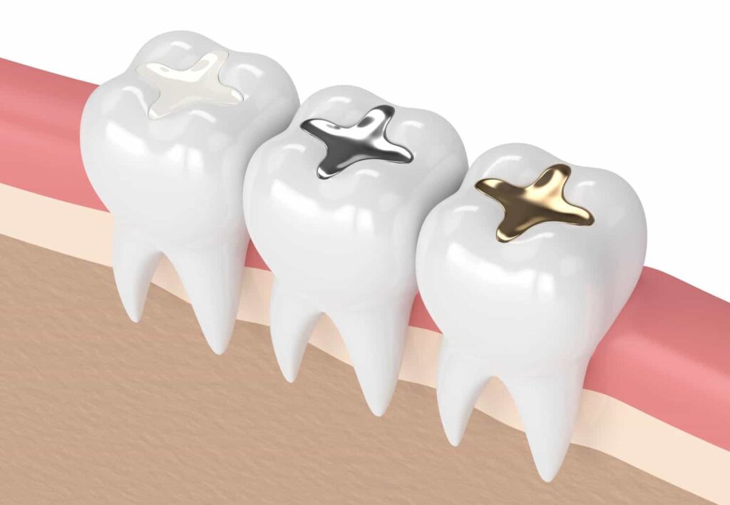 dental fillings near mount colah