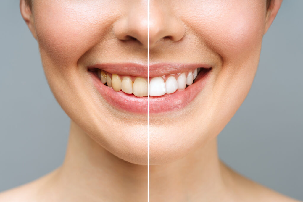 Smile Makeover