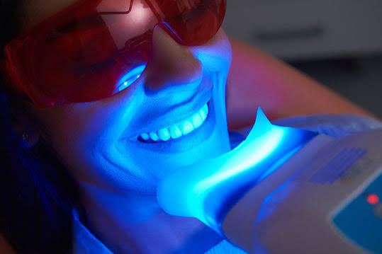 Teeth Whitening Asquith