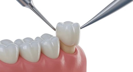 Dental Crowns